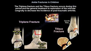 Ankle Fractures In Children  Everything You Need To Know  Dr Nabil Ebraheim [upl. by Akayas]