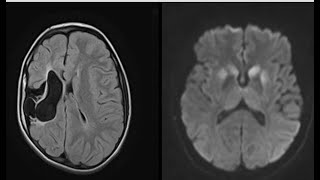 15 caseCNSradiologyneurobrainradiopediafrcrexamstipsamptricksCTMrixrayquestionsbestradi [upl. by Latoniah]