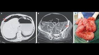 Pneumatosis intestinales mit Pneumoperitoneum [upl. by Lesli]