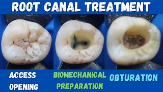 Root Canal Treatment 🔵 Mandibular First Permanent Molar 🟡 access opening ⚪️ BMP 🟣 obturation 🔴 [upl. by Shoifet]