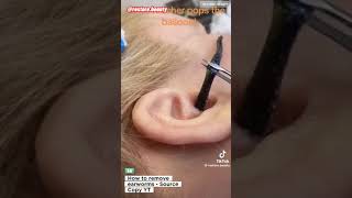 WORMS IN THE EARS YOU WON’T BELIEVE THIS 🙀 How To Remove EARWORMS from the Ears [upl. by Couture68]