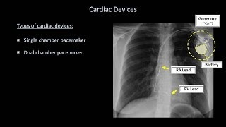 How to Interpret a Chest XRay Lesson 9  Atelectasis Lines Tubes Devices and Surgeries [upl. by Fatima]