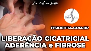 MASSAGEM de LIBERAÇÃO CICATRICIAL PREVENÇÃO ADERÊNCIA FIBROSE Clínica Fisioterapia Dr Robson Sitta [upl. by Tyson569]