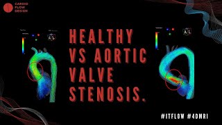 iTFlow Healthy vs Aortic Valve Stenosis evaluation comparison [upl. by Alithea808]