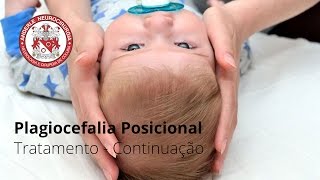 Plagiocefalia Posicional  TRATAMENTO CONTINUAÇÃO  Dr Diogo Neurocirurgião [upl. by Parks200]