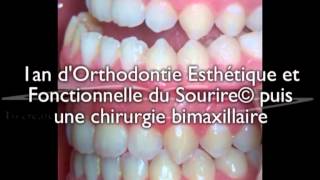 Chirurgie bimaxillaire pour un jeune adulte  correction avec 1an daligneurs® en OEFS© [upl. by Greenwood]