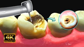 Caries GIGANTE con HONGOS en 4k  Tratamiento de conducto [upl. by Curry]