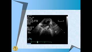 Echo Coarctation of aorta [upl. by Bolanger267]