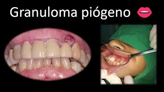 👄 Granuloma piógeno  Cavidad oral  Cabeza y Cuello  Patología [upl. by Danforth]