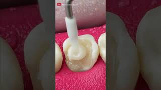 Unbelievable Tooth Restoration asmr restoration [upl. by Sherr494]