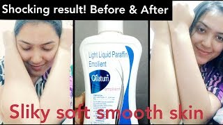 Prevent Itching prickly heatEczemaAcne ampGet smooth Skin with OILATUM EmollientBeforeafter review [upl. by Fagan]