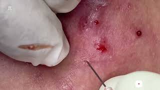 Big Cystic Acne Blackheads Extraction Blackheads amp Milia Whiteheads Removal Pimple Popping [upl. by Nowell263]