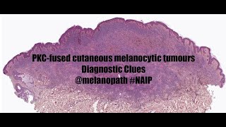 Clues to the diagnosis of PKCfused cutaneous melanocytic tumours NAIP project [upl. by Esinahs]