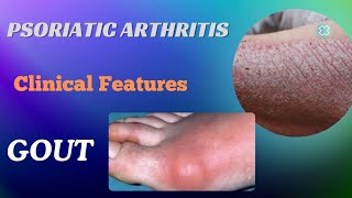 Psoriatic Arthritis amp Gout  Clinical Features Treatment [upl. by Gibbie]