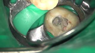 Endoseal root canal filling [upl. by Kubetz]