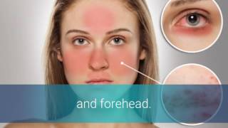 Rosacea Types [upl. by Jule]