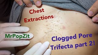 Clogged pores on the chest PART 2 Blackheads steatos and vellus hair cysts Part 1 link below [upl. by Ardnos]