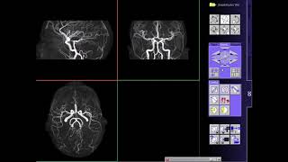 Angiografía Cerebral y Vasos de Cuello [upl. by Ahsirtal]