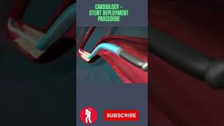 Cardiology Stent Deployment Procedure [upl. by Gnouc]