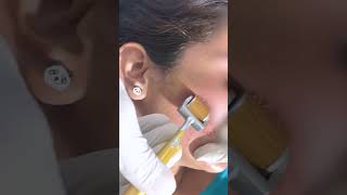 Why You Really Need DERMA ROLLER TREATMENT FOR ACNE SCARS  Viral shorts [upl. by Radnaskela]