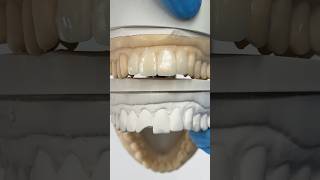 Working to replace a chipped tooth ​⁠EnvisiontecMain envisiontec lsk121shorts dentist teeth [upl. by Pardew]