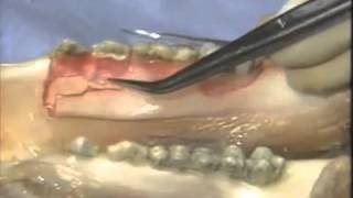 Introductory Periodontal Surgical Techniques The Apically Positioned Flap and Crown Lengthening Y [upl. by Opaline465]