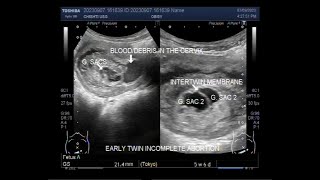 Early Twin Pregnancy with Blighted ovum also called Anembryonic pregnancy [upl. by Oinotnas]