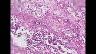 Histopathology TestisEmbryonal carcinoma [upl. by Dale479]