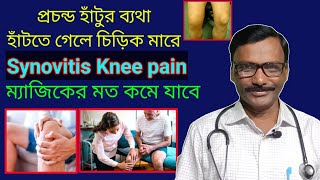 Synovitis knee pain  joint lining inflammation  হাঁটু ব্যথার দ্রুত উপশম  Dr SP Goswami [upl. by Danny]