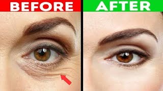 Reasons and Treatment Of wrinkle and Fine lines under the eyes DrVivek Joshi [upl. by Aday670]