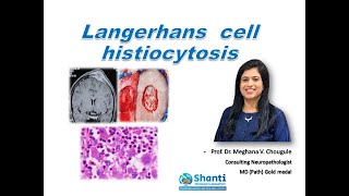 Langerhans cell histiocytosis [upl. by Lawtun973]