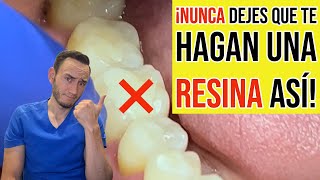 Nunca dejes que te hagan una resina dental así [upl. by Bloxberg]