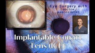 Implantable Contact Lens ICL Procedure [upl. by Sholem618]