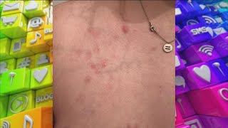 Woman’s Skin Regularly Blisters Pops amp Scabs – Can It Be Treated [upl. by Imelda]