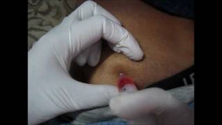 How To Give An IM Injection At Buttocks amp Choose Site For Injection [upl. by Amled]