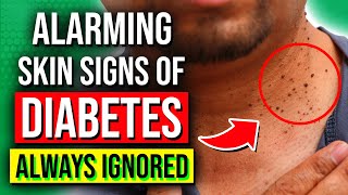 8 ALARMING Skin Signs Of Diabetes You Should NOT Ignore [upl. by Anehsat102]