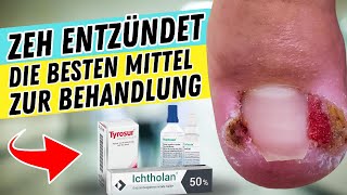 ZEH ENTZÜNDET So behandelst du ihn  Die besten Mittel gegen ENTZÜNDETE ZEHEN amp NAGELBETTENTZÜNDUNG [upl. by Adirem]