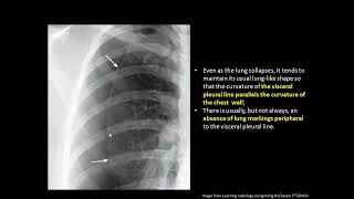 Lecture 7  Pneumothorax pneumomediastinum pneumopericardium and subcutanous emphesyma [upl. by Iaverne]