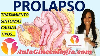 PROLAPSO DE ÓRGANOS PÉLVCOS SÍNTOMAS TIPOS EXPLORACIÓN TRATAMIENTO Ginecología y Obstetricia [upl. by Edecrem614]