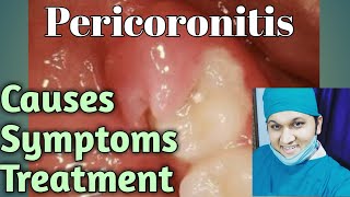 Pericoronitis Types Causes Signs Symptoms Treatments [upl. by Nagey902]