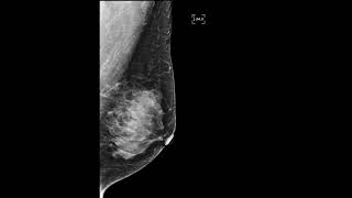 유방 석회화양성macrocalcification [upl. by Ahsiam]