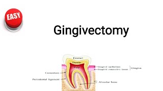 Gingivectomy [upl. by Aihsenot769]