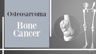 bone cancer  Osteosarcoma [upl. by Armstrong239]