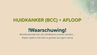 Huidkanker BCC basaalcelcarcinoom avontuur en afloop  CuradermBEC5 bij basaalcelcarcinoom [upl. by Jose]