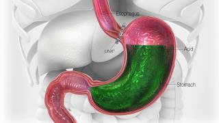 New Surgical Procedure to Help Cure Acid Reflux [upl. by Oahc]