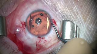 Chirurgie implant phake myopique ICL [upl. by Razec]