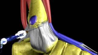 Osteoartrosis de Tobillo Synvisc Simulacion [upl. by Nwadrebma]