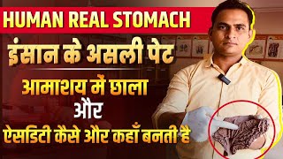 FullVideoAcidity amp Gastric Ulcer in Real Stomach  इंसान के असली पेट में ऐसिडिटी और छाले viral [upl. by Greiner]