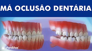 Má oclusão dentária  Classificação das maloclusões © [upl. by Einre]