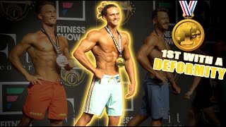 I WON a Bodybuilding Show with a Sunken Chest Deformity Pectus Excavatum [upl. by Leclair]